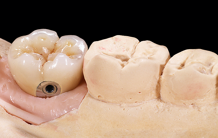 Implant Bridge Restoration